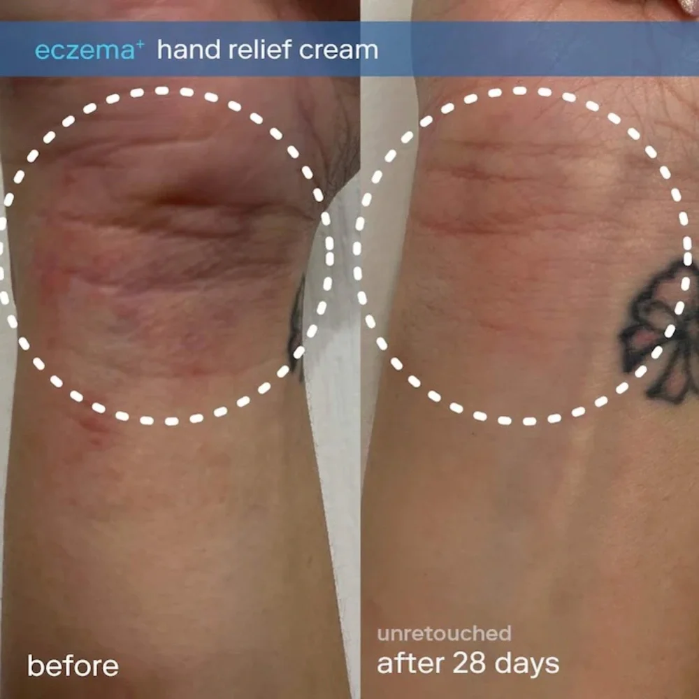 🆕 SKINFIX Eczema+ Ceramide Hand + Foot Relief Cream 90mL New & Sealed